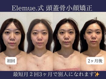 エレミュー 烏丸(Elemue.)/究極の小顔　6回目／10回コース