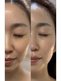 ミリュール(Millule)&nbsp;リフトアップ1回の効果。ほうれい線が目立たなくなりました