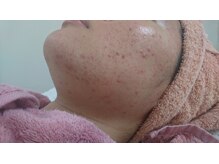 サロンエム(Salon m)/ニキビケア