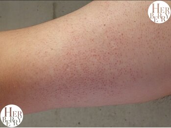 ハーバリー ハーブピーリング 栄(HERBERRYハーブピーリング)/ハーブピーリング専門店HERBERRY