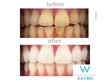 ホワイトニングショップ 奈良生駒店/喫煙されてる方も白くなる！