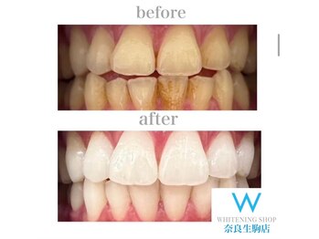 ホワイトニングショップ 奈良生駒店/喫煙されてる方も白くなる！