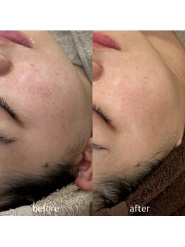 タグ 高知駅前店(Tug)/【毛穴・美白】剥離