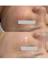 みるん(milne.)/カルディションフェイシャル