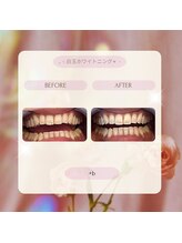 プラスビーセルフ(+b self)/ホワイトニングビフォーアフター