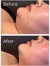 クイーンズ ピュア 恵比寿店(Queen's Pure)/小顔・むくみケア