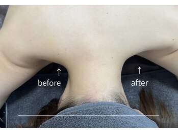 ビノスビューティー(vinos.beauty)/症例写真　肩こり首凝りライン