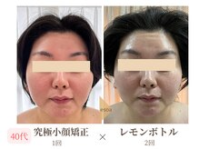 エソア(esoa)/40代　小顔矯正×レモンボトル