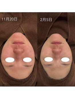 テンニック(10nick)/【赤み改善】