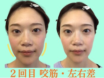 ナチュラルビューティーフェイス 横浜(NBF)/咬筋、口角の歪み/横浜小顔矯正