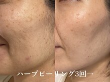 シュリー(Sriii)の雰囲気（ハーブピーリングで肌質改善◎くすみシミ改善し若々しい印象に♪）