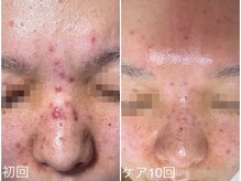 ラブリボン/短期プログラム