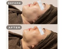 ガーオガーオ 新宿 四ツ谷(GaaoGaao)/ハーブピーリング/1回目