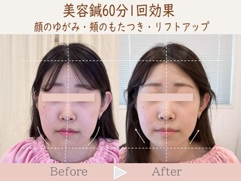 ネテマテ 表参道(netemate)/美容鍼×鍼灸