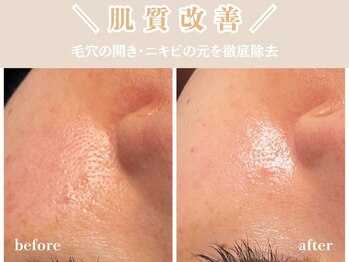 レッド(RED)/毛穴ケア