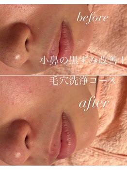 ディオーネ 新潟けやき通り店(Dione)/敏感肌でもできる美肌脱毛！