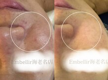 アンベリール(Embellir)/REVIピーリング/1回目→3回目