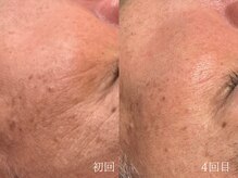 ウォーム(warm)/シワケア/小顔/マッサージ/小顔