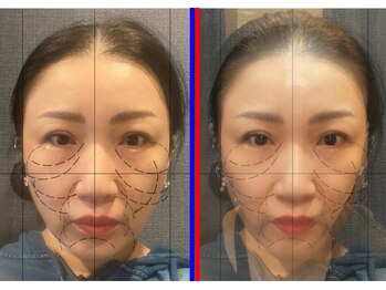 セブンシーズ 上野店(Seven Seas)/フェイシャル最先端技術[超音波]