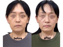 けいのき鍼灸整骨院/顔の左右差8回の変化!小顔矯正