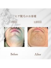 クリスタル(Crystal)/men's顔脱毛★素敵は変えられる