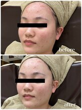 ジャスミン(Jasmin)/オーダーメイド高濃度原液導入