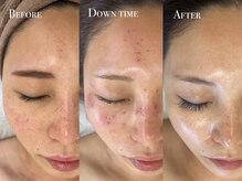 イースト(EAST)/シミケア5回／プラズマ10回以上