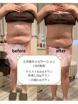 アマンジオ/オットー 新居浜店(amanjiwo/Otto)/キャビテーション・Before/After