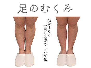 レジスタ(REGISTA)/【筋膜リリース】before after