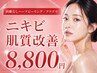 【ニキビ悩みNo.1☆】アクネ菌殺菌プラズマ×剥離なしハーブピーリング