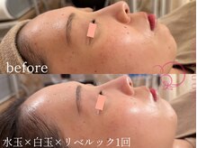 サロンヴェアリー 広尾(salon vary)の雰囲気（速攻性が人気リベルック。天然色素を肌注入！一瞬でくすみ飛ぶ！）