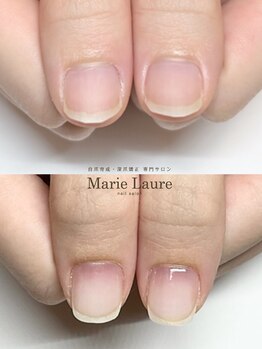 マリーロール 梅田店(Marie Laure)/自爪育成/深爪矯正/ネイルケア