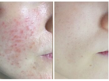 リミューズ マロアマーノ(Re.MUSE MAROaMano)/before/afte５回　【集中ケア】