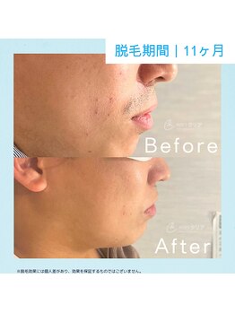 メンズクリア 藤沢OPA店/【メンズクリア】お客様の施術例