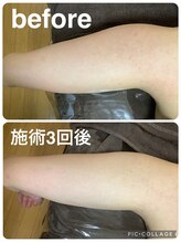 ギンザアール(GINZA R.)/二の腕に徹底アプローチ◎