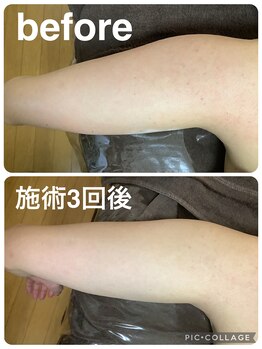 ギンザアール(GINZA R.)/二の腕に徹底アプローチ◎