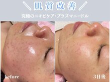 レッド(RED)/ニキビケア