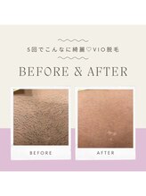 エアリアル 八女店/人気No.1のVIO脱毛before、after