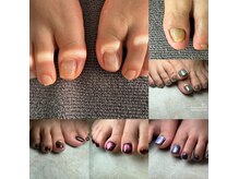 #フットネイル#角質#フットケア#巻爪矯正は冬の時期に！