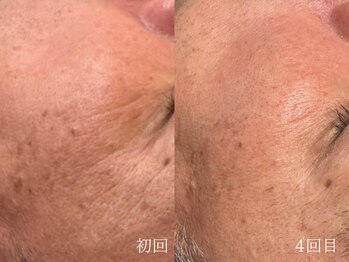 ウォーム(warm)/シワケア/小顔/マッサージ/小顔