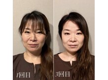 鍼灸院エミュ(Emu)/コリが取れるとくすみも改善