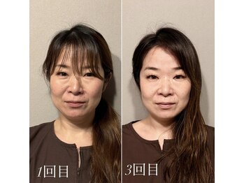 鍼灸院エミュ(Emu)/コリが取れるとくすみも改善
