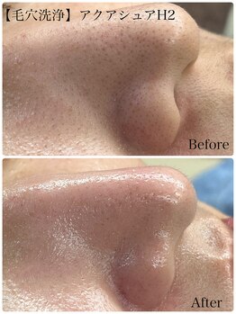 アンティミテ(Intimite)/毛穴洗浄【アクアシュアH2】