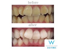 ホワイトニングショップ 奈良生駒店/歯の並び悪い方でも大丈夫！