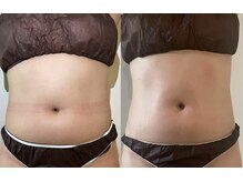 ミオン(美温)/腸もみ