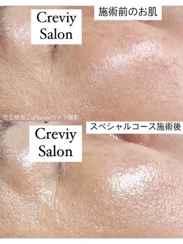 クレヴィー(Creviy)/オプション5つ入りハーブ