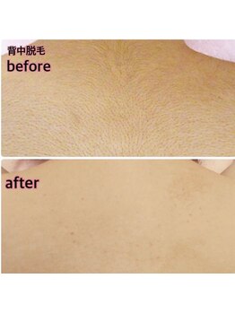 ラウレア 西条店(LAULEA)/背中脱毛Before/After 