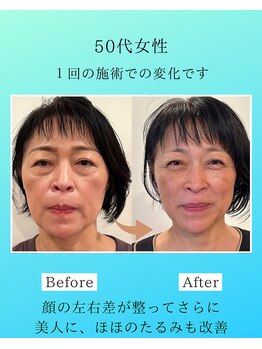 マハロ 海老名店(Mahalo)/小顔矯正　50代女性