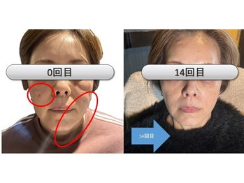 ニコ(Nico.)/シミが消え、リフトアップ