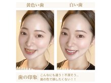 白く輝く歯は第一印象に大きく影響＊数回で理想の白い歯に♪